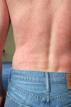 This image depicts a posterior view of a patient’s back, captured in a clinical setting, upon presenting with this blotchy rash. After a diagnostic work-up, it was determined that the rash had been caused by the Zika virus. Note: Not all patients with Zika get a rash CDC image